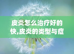 皮炎怎么治疗好的快,皮炎的类型与症状